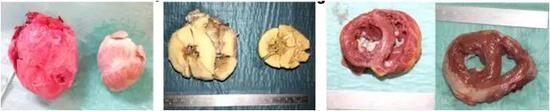 第二組狒狒移植的豬心臟出現過度增殖。圖片來源：文獻